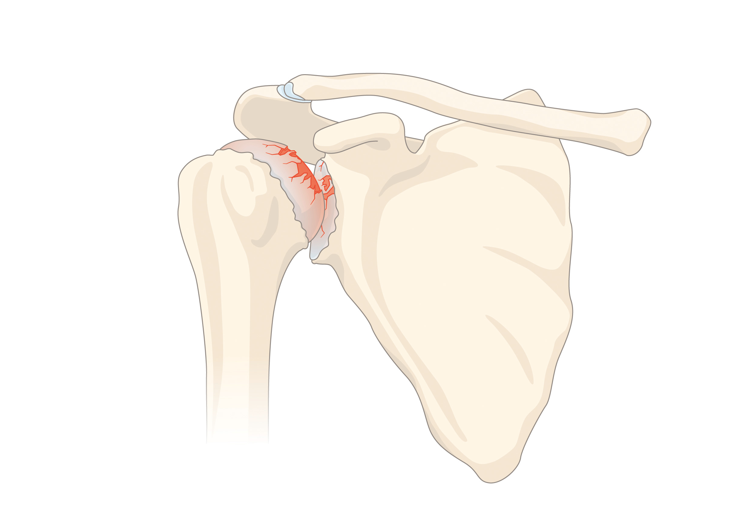 Illustration: Schultergelenksarthrose mit aufgebrauchtem Knorpel zwischen Oberarmkopf und Schulterpfanne